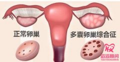 多囊卵巢怎么治疗？
