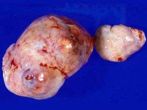 卵巢泡膜细胞瘤