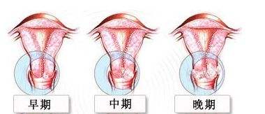 外阴囊性肿瘤如何诊断检查