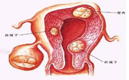 外阴囊性肿瘤要怎么治疗？