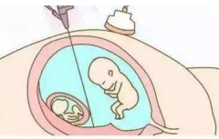 试管婴儿如何减胎术怎么操作，什么时候减胎？