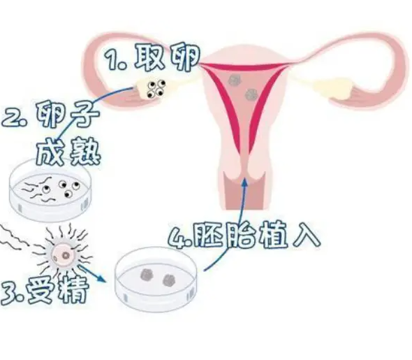 试管婴儿
